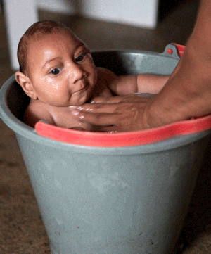 Este bebé nació con el cráneo pequeño debido a que su madre fue infectada con el virus de Zika.