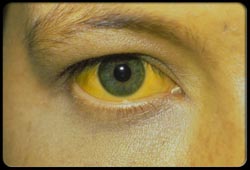 La hepatitis se refleja en los ojos.