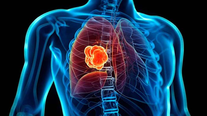 Charlas sobre cáncer de pulmón esta semana: NewYork-Presbyterian